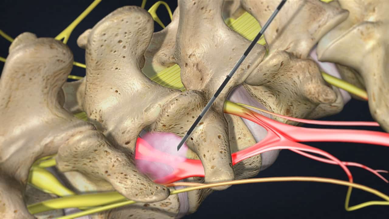 lumbar spinal nerves