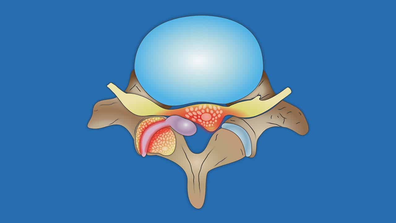 Киста Тарлова — Prof. Dr. Erkan Kaptanoğlu