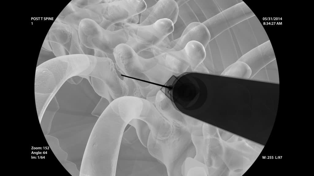 Injektion in das Kostotransversalgelenk (fluoroskopische Aufnahme)