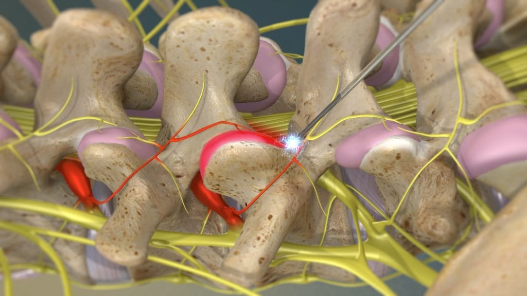 Радиочастотная нейротомия (проверка электрода)
