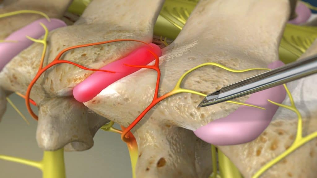 Radiofrequenz-Neurotomie (Einführung der Sonde)