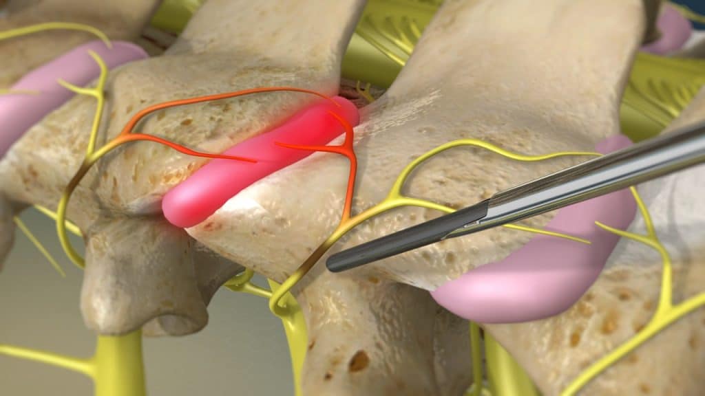 Radiofrequenz-Neurotomie (Überprüfung der Sonde)