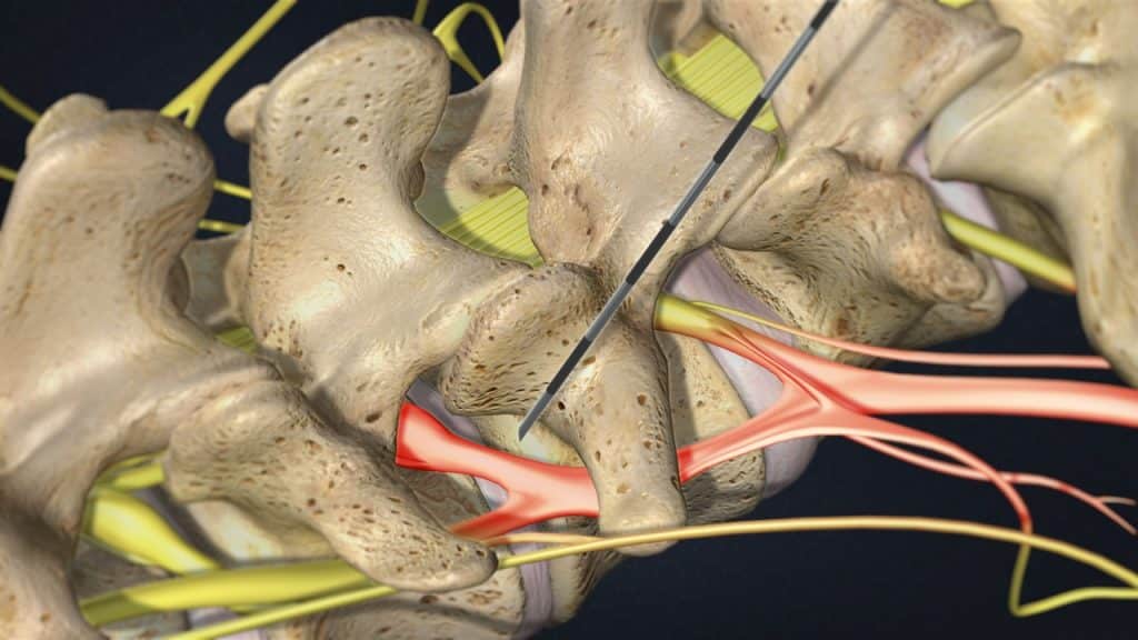 Lumbale Spinalnervenanalgesie (gereizte und schmerzhafte Nervenwurzel, Position der Nadel)