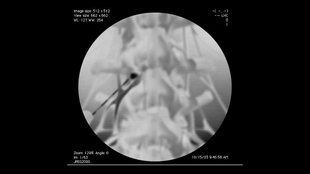 Поясничная трансфораминальная эпидуральная стероидная инъекция (L3) (рентгенографическое изображение)