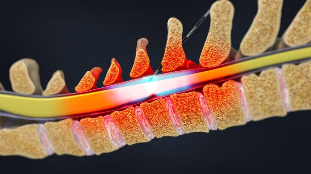 Zervikale interlaminäre epidurale injektion (Medikation)