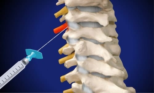 Zervikale Spinalnervenanalgesie (gereizte und schmerzhafte Nervenwurzel, Position der Spritze)