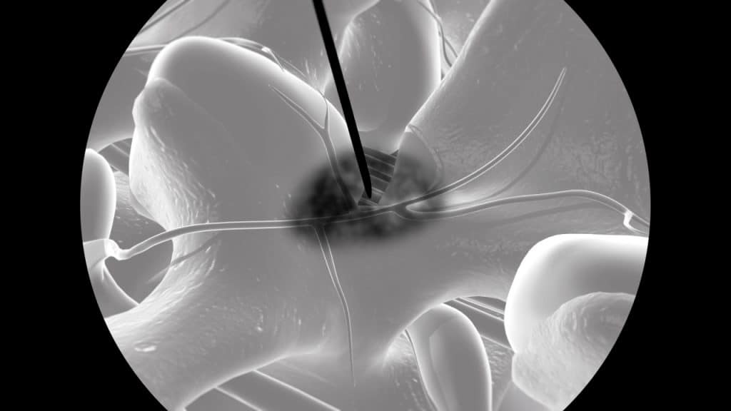 Infiltration des medialen Nervenastes (fluoroskopische Aufnahme)