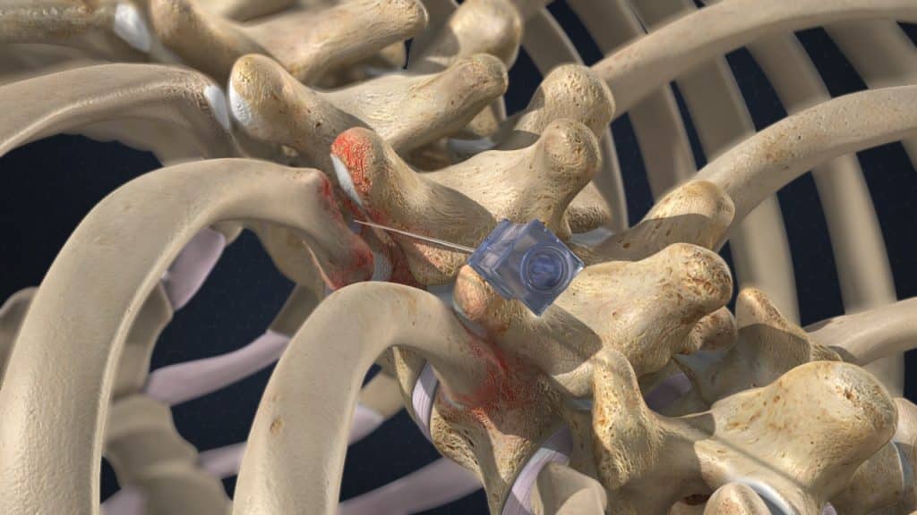 Schmerzhaftes Kostotransversalgelenk (Nadelposition)