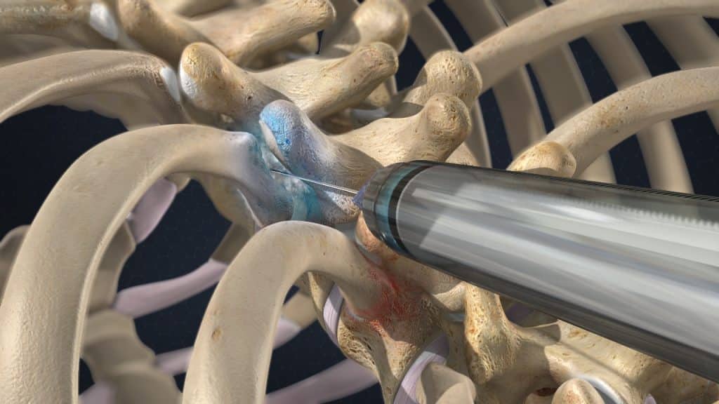 Injektion in das Kostotransversalgelenk (Schmerzlinderung)