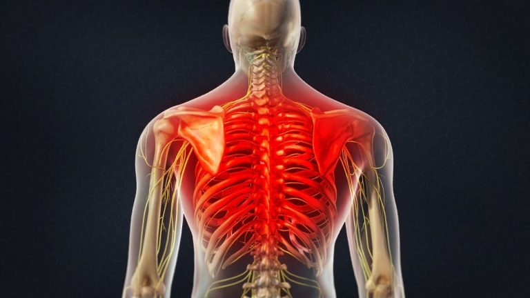 Thoracic Trigger Point Infiltration
