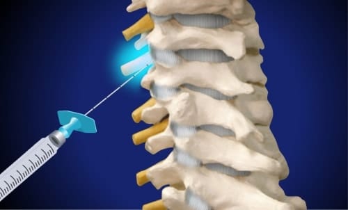 Zervikale Spinalnervenanalgesie (Desensibilisierung der gereizten Nervenwurzel)