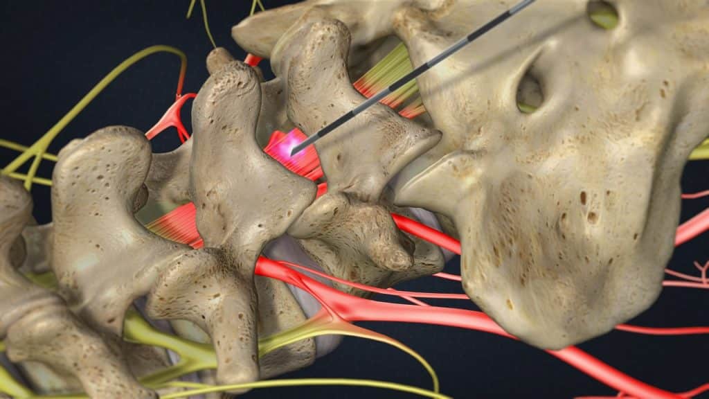 Lumbale epidurale dorsale (interlaminäre) Injektion (gereizte und schmerzhafte Nervenwurzeln, Platzierung der Nadel)