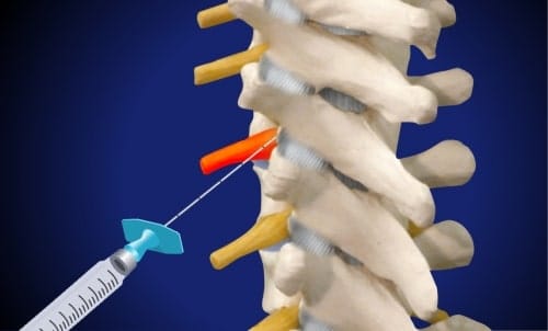 Thorakale Spinalnervenanalgesie (gereizte und schmerzhafte Nervenwurzel, Position der Spritze)