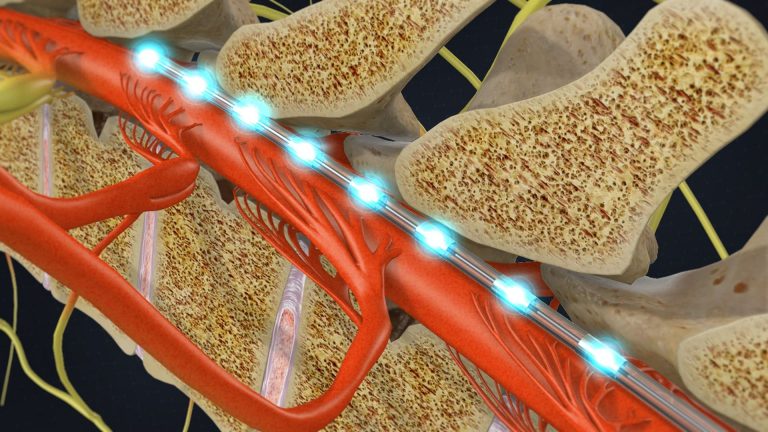 Neuromodulation Therapies - Pain Management Solutions