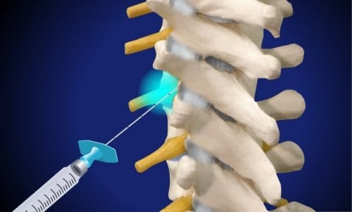 Thorakale Spinalnervenanalgesie (Desensibilisierung der gereizten Nervenwurzel)