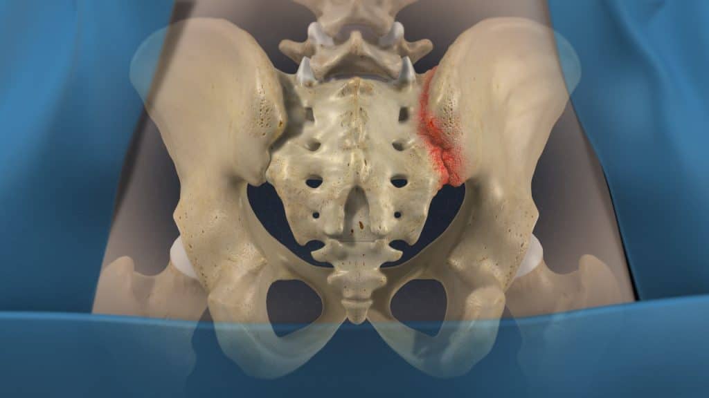 Sacroiliac joint pain (posterior view)