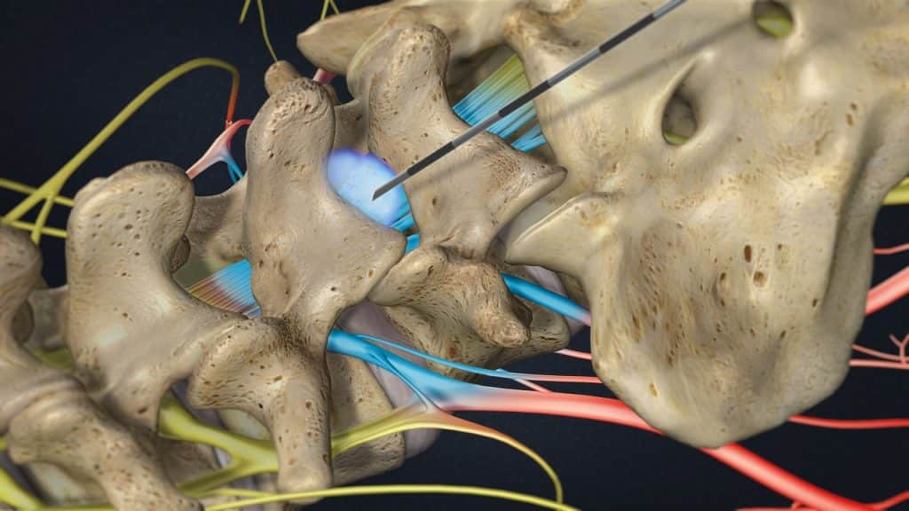 Lumbale epidurale dorsale (interlaminäre) Injektion (Desensibilisierung der gereizten Nervenwurzeln)