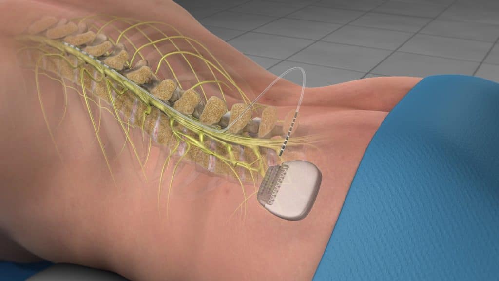Spinal Cord Stimulator (generator inserted, lead connected)