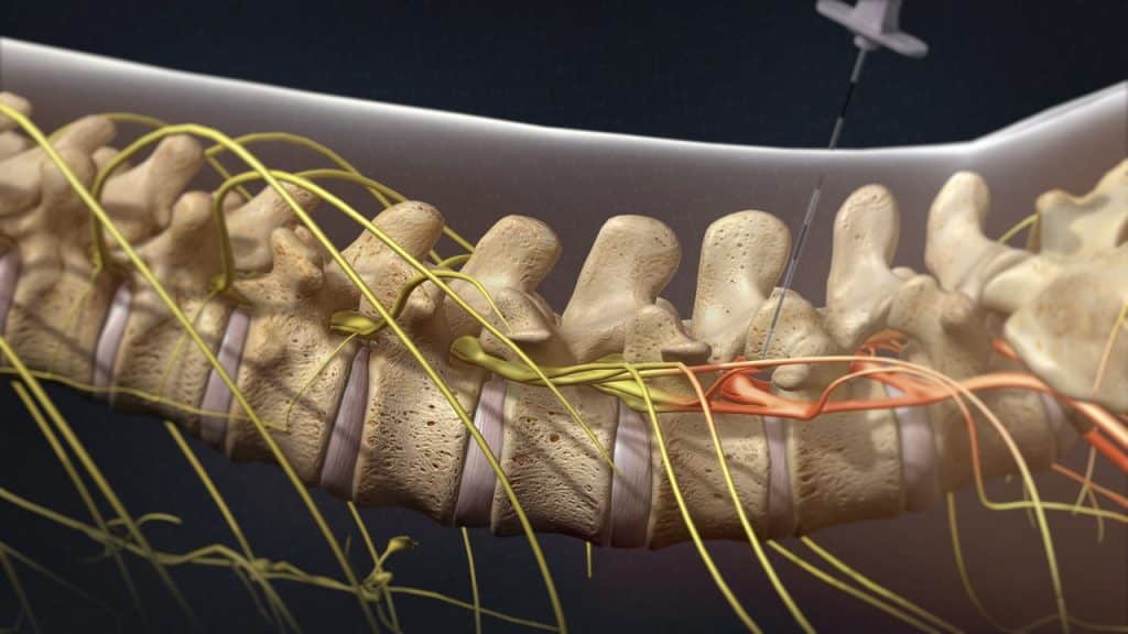 Поясничная трансфораминальная эпидуральная стероидная инъекция (L3) (раздраженный и болезненный нервный корешок, установка иглы, вид сбоку)