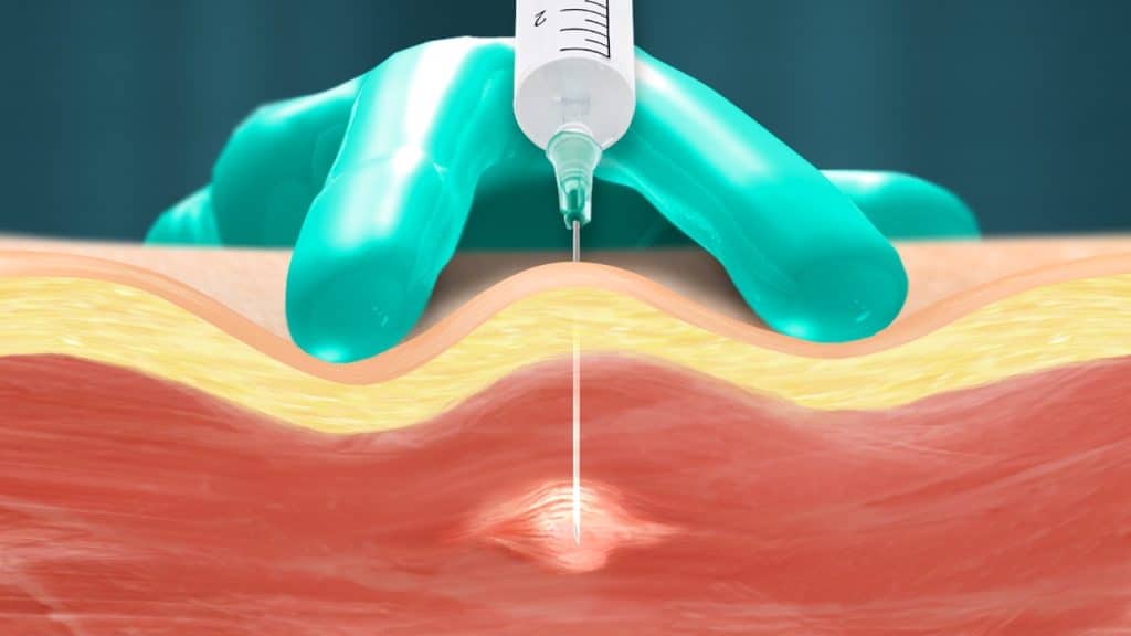 Trigger point injection