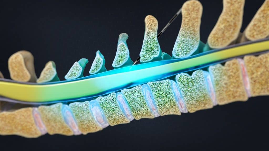 Zervikale interlaminäre epidurale Injektion (Schmerzlinderung)