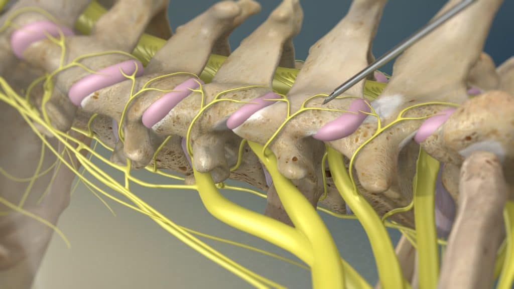 Radiofrequenz-Neurotomie (Platzierung der Nadel)