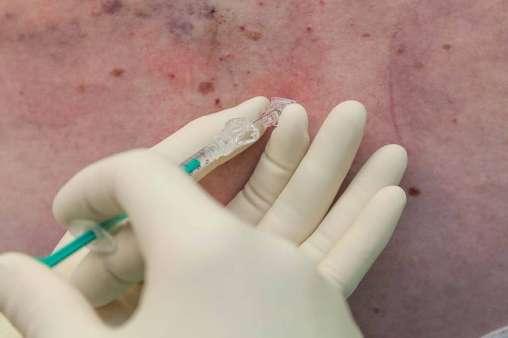 Epidural Perineural Injection (injection)