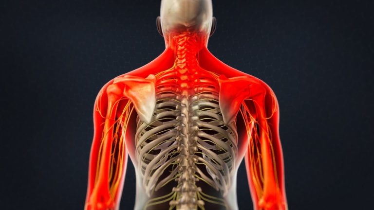 Cervical Transforaminal Epidural Steroid Injection