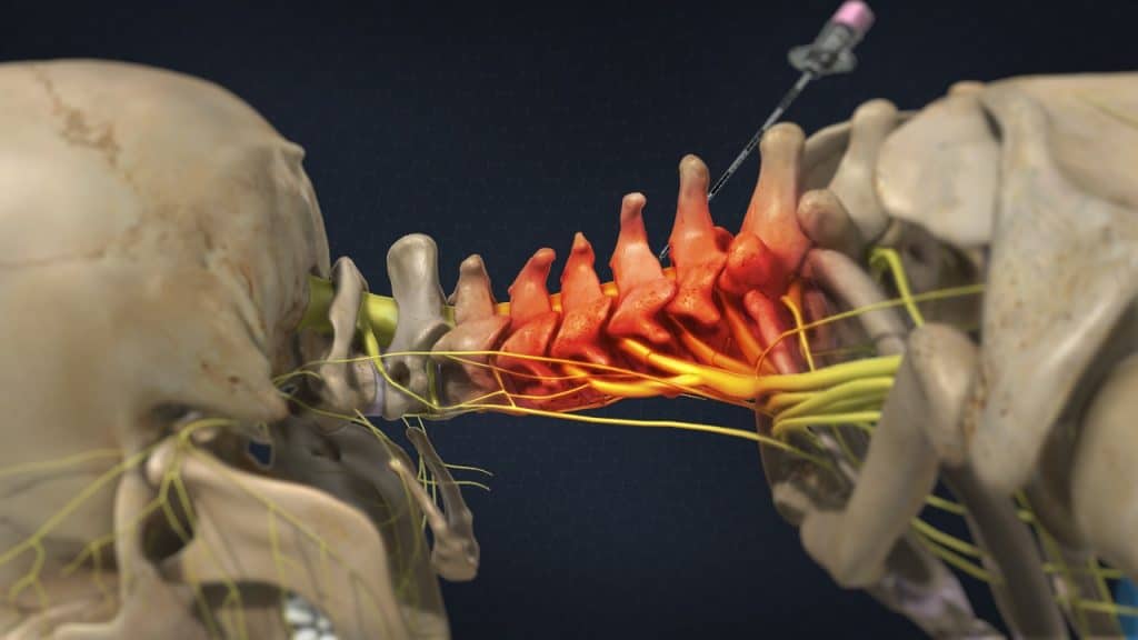 Zervikale interlaminäre epidurale injektion