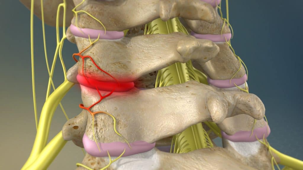 Schmerzhafte zervikale Facettengelenke (Detailansicht)