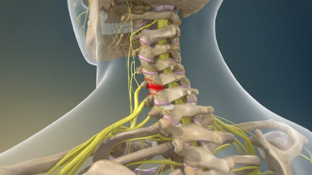 Schmerzhafte zervikale Facettengelenke
