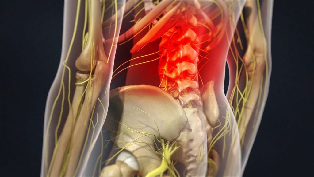 LUMBAR FACET INFILTRATION