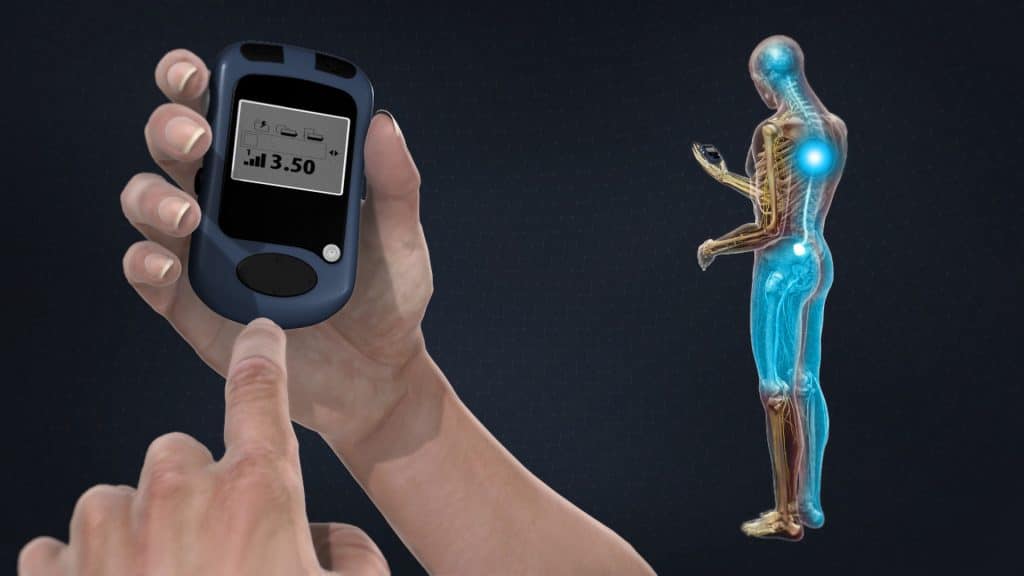 Spinal Cord Stimulator (external programming, complete pain reduction)