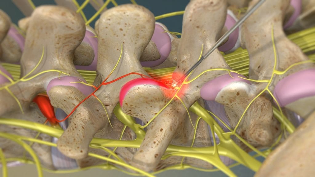 Радиочастотная нейротомия (активация электрода)