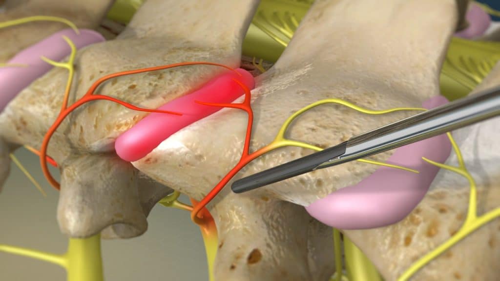 Radiofrequenz-Neurotomie (Platzierung der Sonde)