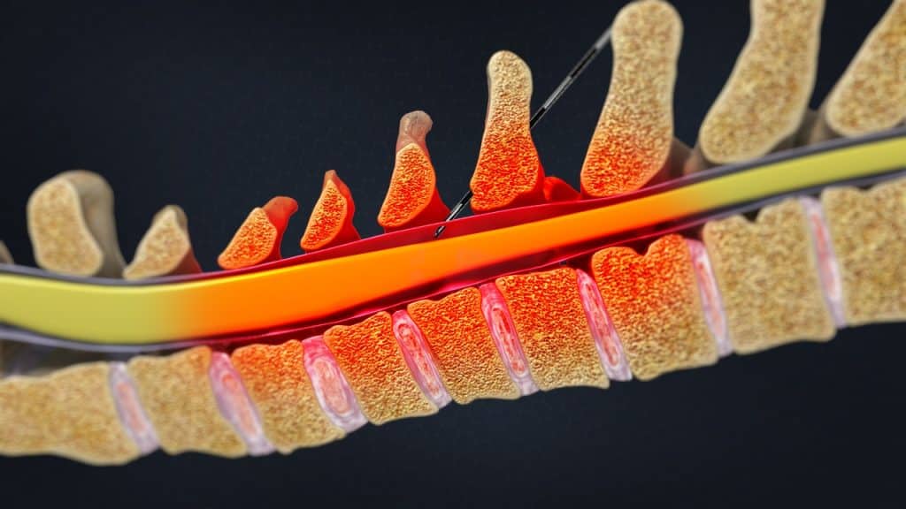 Zervikale interlaminäre epidurale injektion (Nadel durch die Dura)