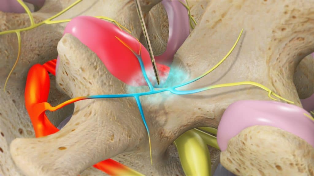 Infiltration des medialen Nervenastes