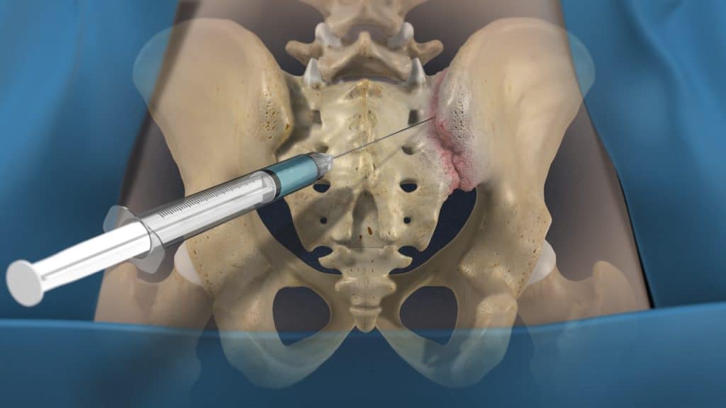 Sacroiliac joint infiltration (in process)