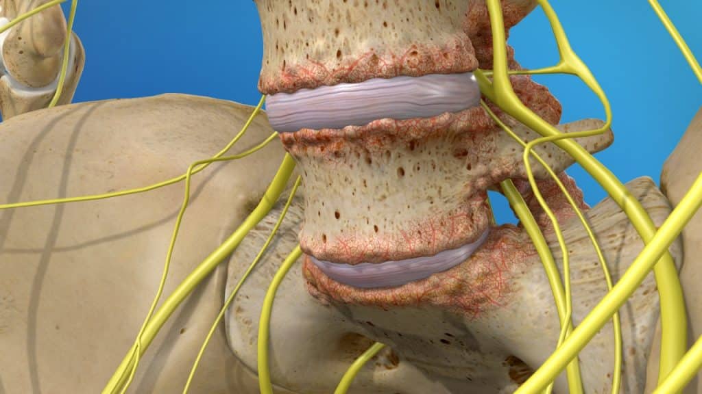 Lendenwirbelsäule mit Osteophyten (Arthrose der Wirbelsäule)