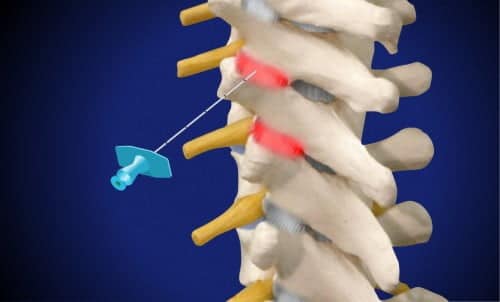 Έγχυση στις θωρακικές ζυγοαποφυσιακές αρθρώσεις (βελόνα στην πάνω άρθρωση)