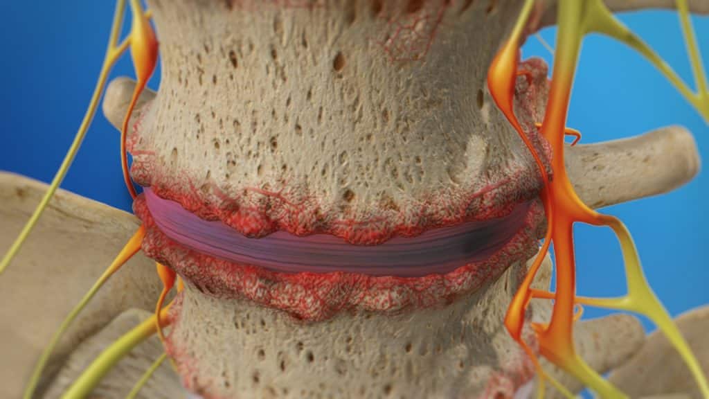 Εκφυλισμένος δίσκος στην οσφυϊκή μοίρα της σπονδυλικής στήλης