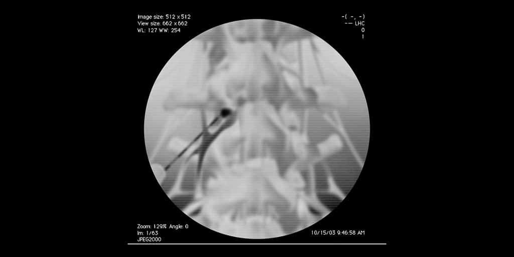 Οσφυϊκή διατρηματική επισκληρίδιος έγχυση (O3), (ακτινοσκοπική εικόνα)