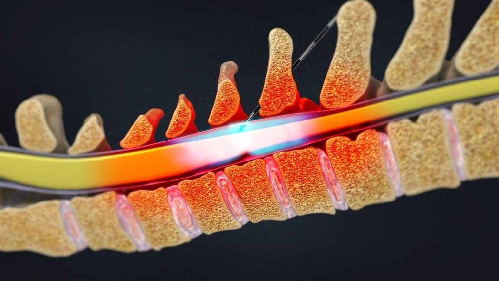 Zervikale interlaminäre epidurale Injektion (Medikation)