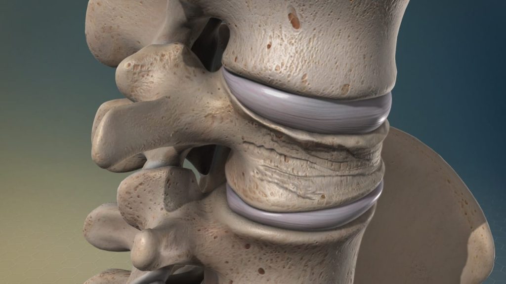 Компрессионные Переломы Позвоночника