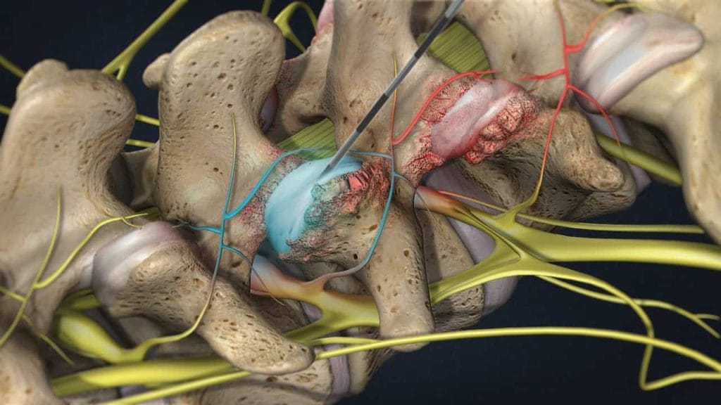 Διήθηση ζυγοαποφυσιακής άρθρωσης (πάνω ζυγοαποφυσιακή άρθρωση)