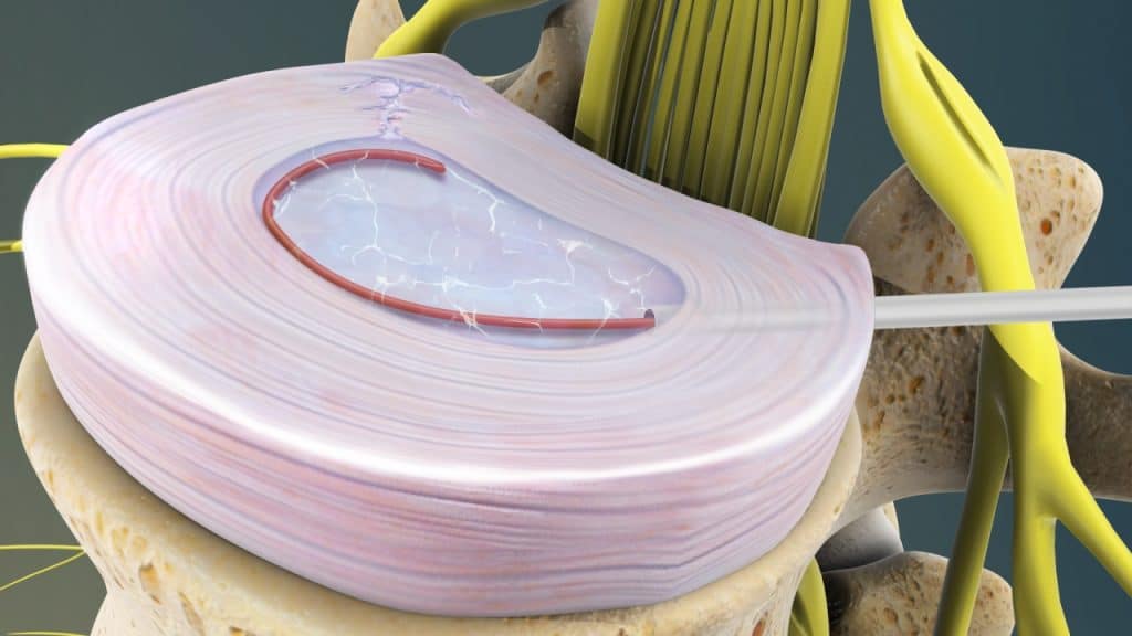 Intradiskale elektrothermale Therapie (Heilung des Risses/Spaltes)