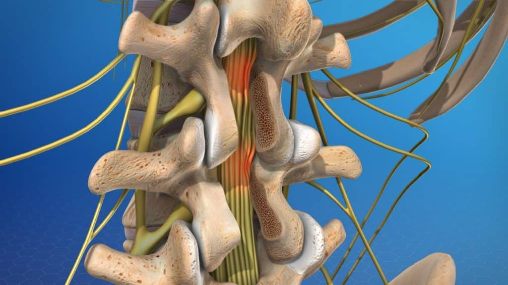 Post laminectomy syndrome (nerve root pain)