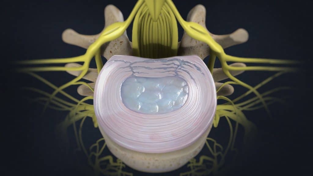 Lumbale Bandscheibe mit sehr geschwächtem Faserring (Ansicht von oben)