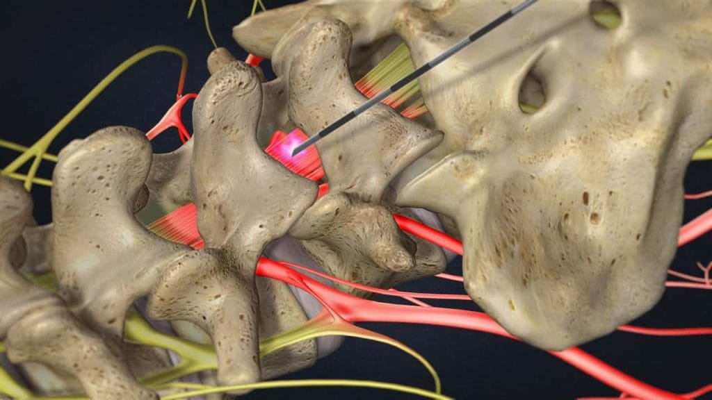 Οσφυϊκή οπίσθια (διαπεταλική) επισκληρίδιος έγχυση (ερεθισμένες και επώδυνες νευρικές ρίζες, τοποθέτηση βελόνας)