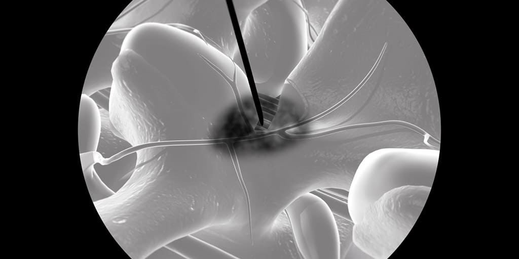 Διήθηση οσφυϊκού έσω νευρικού κλάδου (ακτινοσκοπική εικόνα)